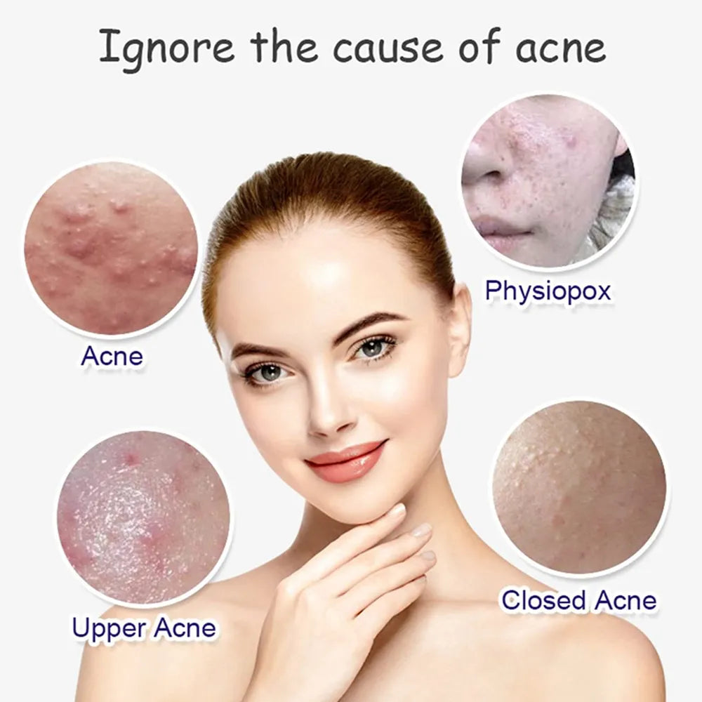 Aichun Beauty Anti Acne Facial Serum